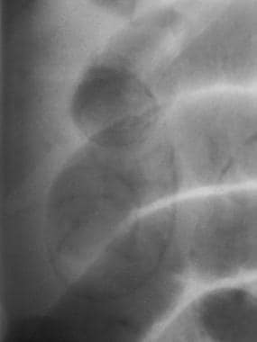 Radiograph of a 79-year-old woman with several hou