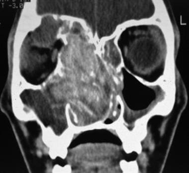 Coronal CT scan showing extensive allergic fungal 