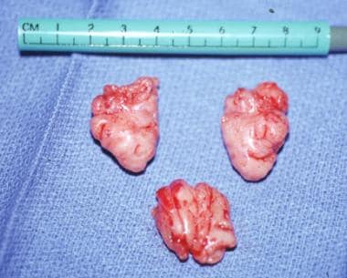 Picture of the tonsils superiorly and adenoids inf