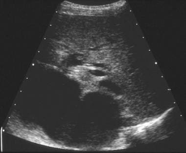 pancreatic pseudocyst ultrasound