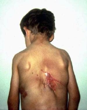 Scoliosis with scar resulting from prior surgical 