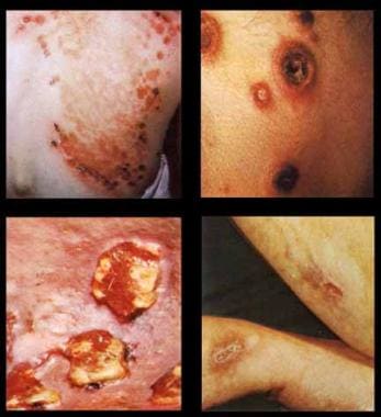 Third-stage gummatous lesions.