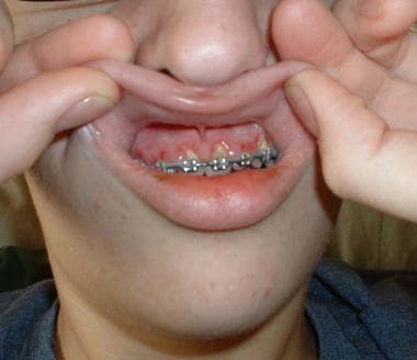单色细胞患者的牙龈增生