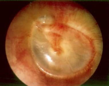 Chronic otitis media with a retraction pocket of t