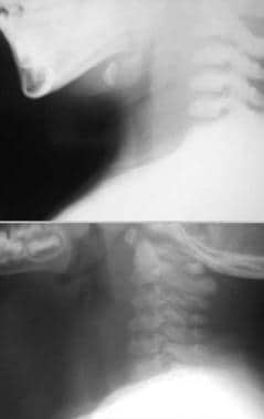 Plain lateral neck x-ray. Top radiograph reveals w