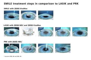 SMILE treatment steps in comparison to LASIK and P