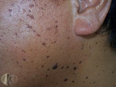 Dermatosis papulosa nigra. Courtesy of DermNet New