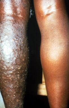 Patient from Cameroon with sowdalike lesions. 