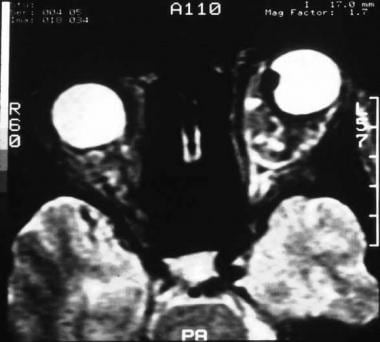 T2-weighted MRI showing a small anterior choroidal