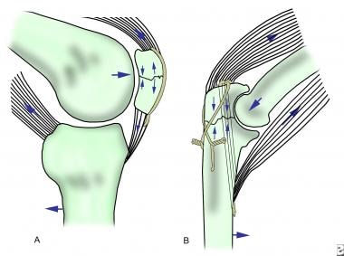 General Principles of Internal Fixation: History of Fracture Treatment,  Fracture Repair Biology, Pins, Wires, and Screws