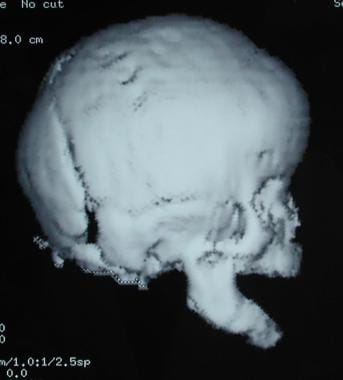 Craniosynostosis management. Preoperative CT image