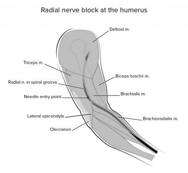 Radial nerve block at the humerus level. 
