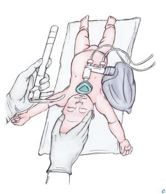 Positioning of infant for intubation. 