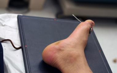 Nail embedded in the foot, propelled by nail gun t
