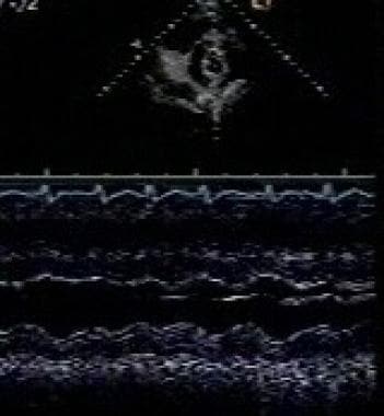 M-mode echocardiogram from a 70-year-old woman sho
