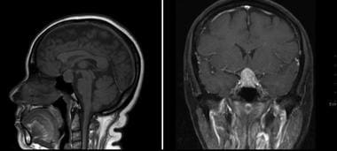 Pituitary Tumors Pathology. Neuroimaging of pituit