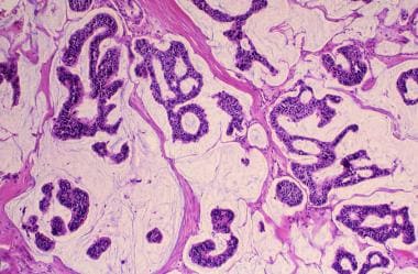 invasive ductal carcinoma histology