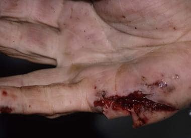 Laceration of a palm placed over the cylinder gap 