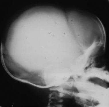 Skull radiograph in a premature baby. The skull va