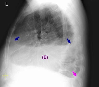 Lateral chest radiograph in a 50-year-old man with