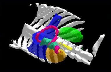 Three-dimensional treatment planning uses CT scan 