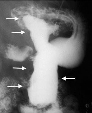 Gastric gastrointestinal stromal tumor with huge e