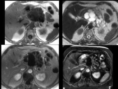 MRIs of serous cystadenoma. Top left, T1-weighted 