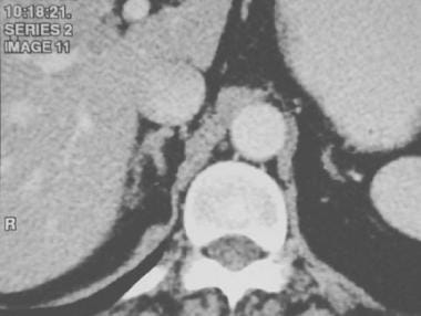 Contrast-enhanced axial CT scan of a normal right 