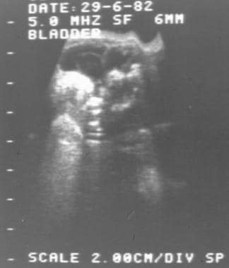 Ultrasonographic scan of the bladder of a child wi