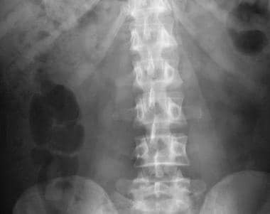 Plain abdominal radiograph in an adult man with me