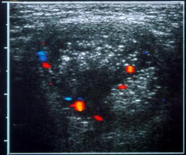 Testicular torsion. Scrotal hernia. Transverse col