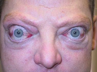 Severe proptosis and eyelid retraction from thyroi