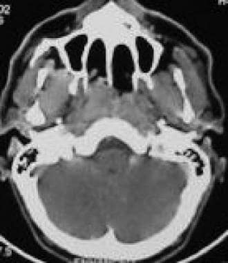 Contrast-enhanced CT scan shows nasal involvement 