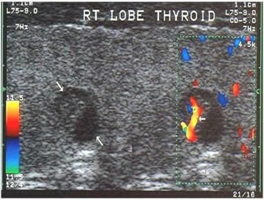Planar and color Doppler image showing a cystic pa