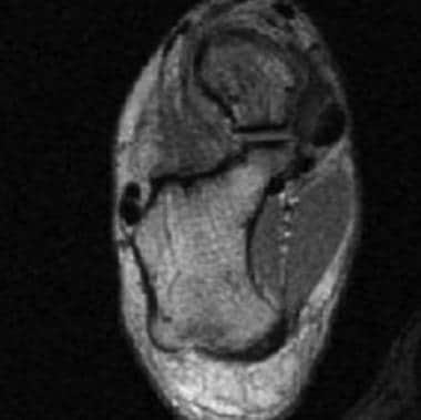 Axial T1-weighted MRI of the ankle depicts the nor