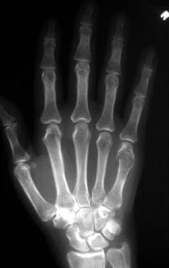 Frontal radiograph of the right hand demonstrates 