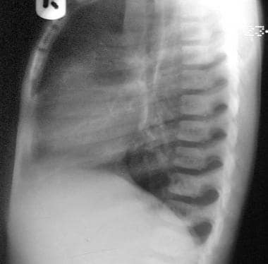 Radiograph of the dorsal spine shows the classic r