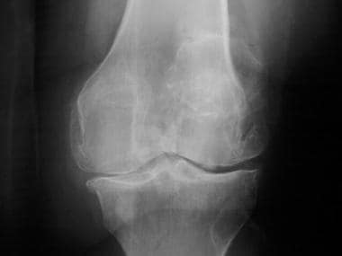 Standing radiograph of the knee reveals narrowing 