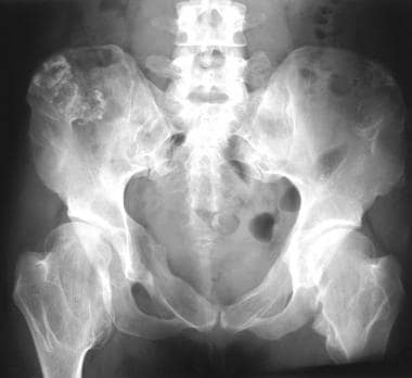 Plain radiograph of the pelvis in a 41-year-old wo