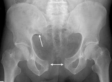 Anteroposterior compression injury as seen on an a