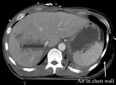 Axial computed tomography image of the chest in a 