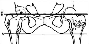Illustration of the vertical assessment of a femor