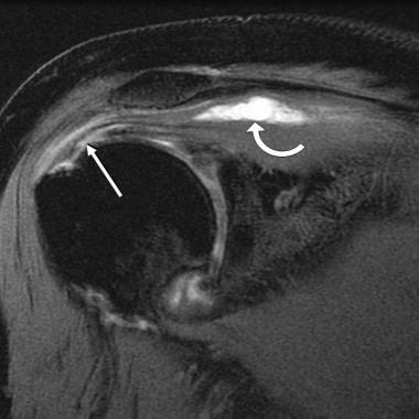 Intramuscular cyst and partial-thickness tear. 