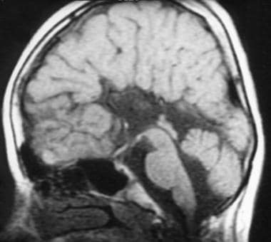 This sagittal T1-weighted MRI shows agenesis of th
