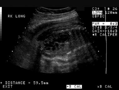 Prenatal longitudinal sonogram of the right kidney