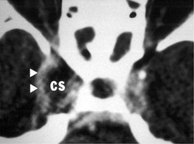 Axial CT image of a patient with a focal stenosis 