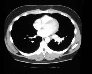 Pulmonary angiography. CT image in a 24-year old m