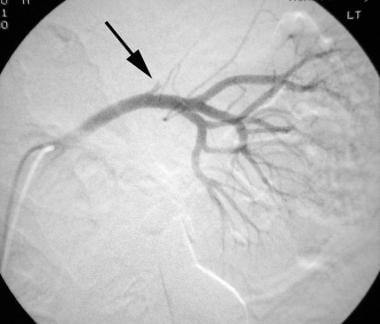 Selective left renal angiogram in an older man wit
