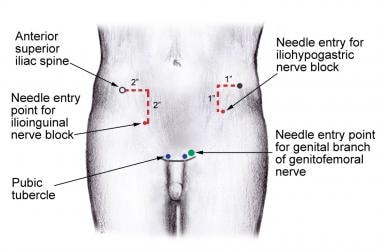 iliohypogastric nerve