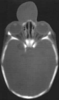 CT scan demonstrating encephalocele. 